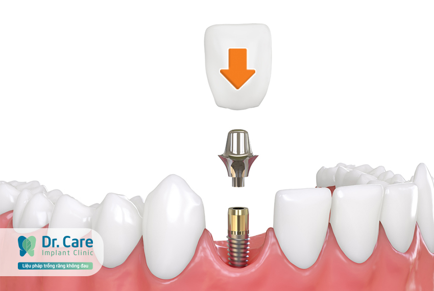 Quy trình trồng răng Implant thay thế 1 răng