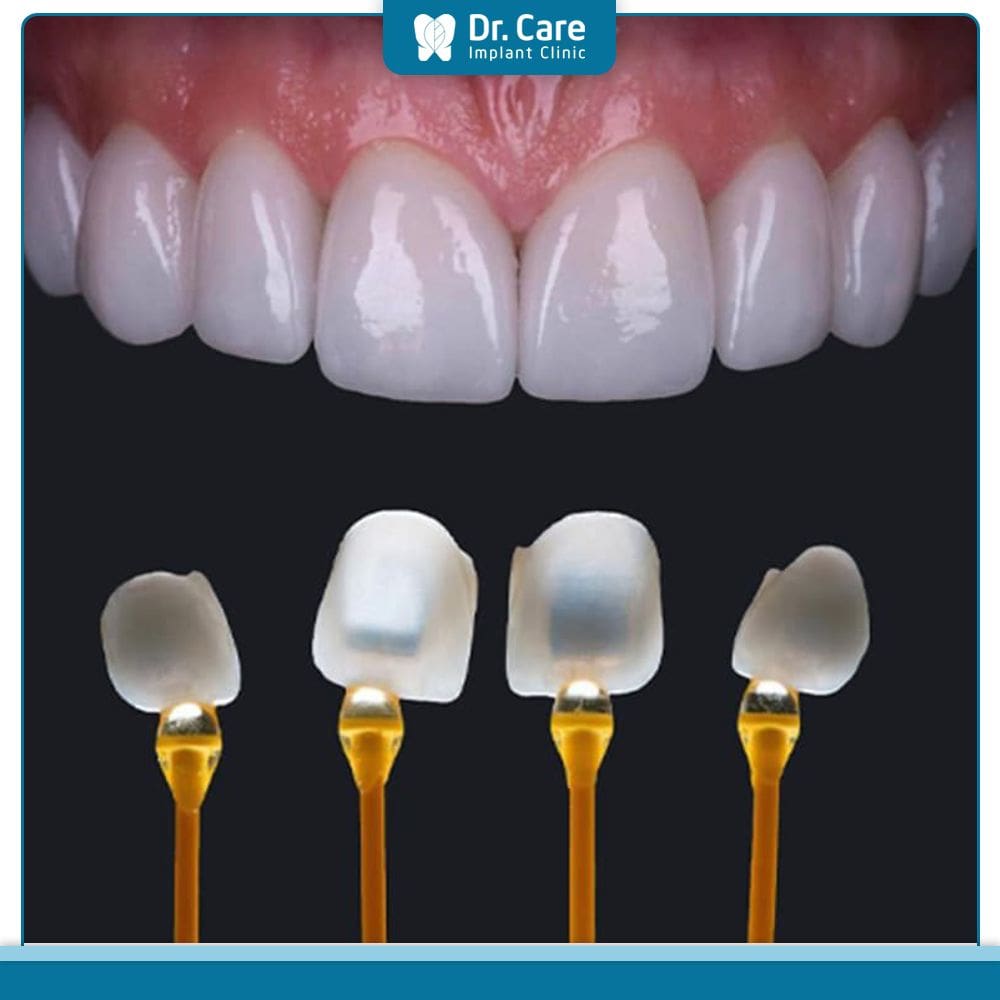 Bọc răng sứ nguyên hàm nên sử dụng chất liệu răng sứ nào?