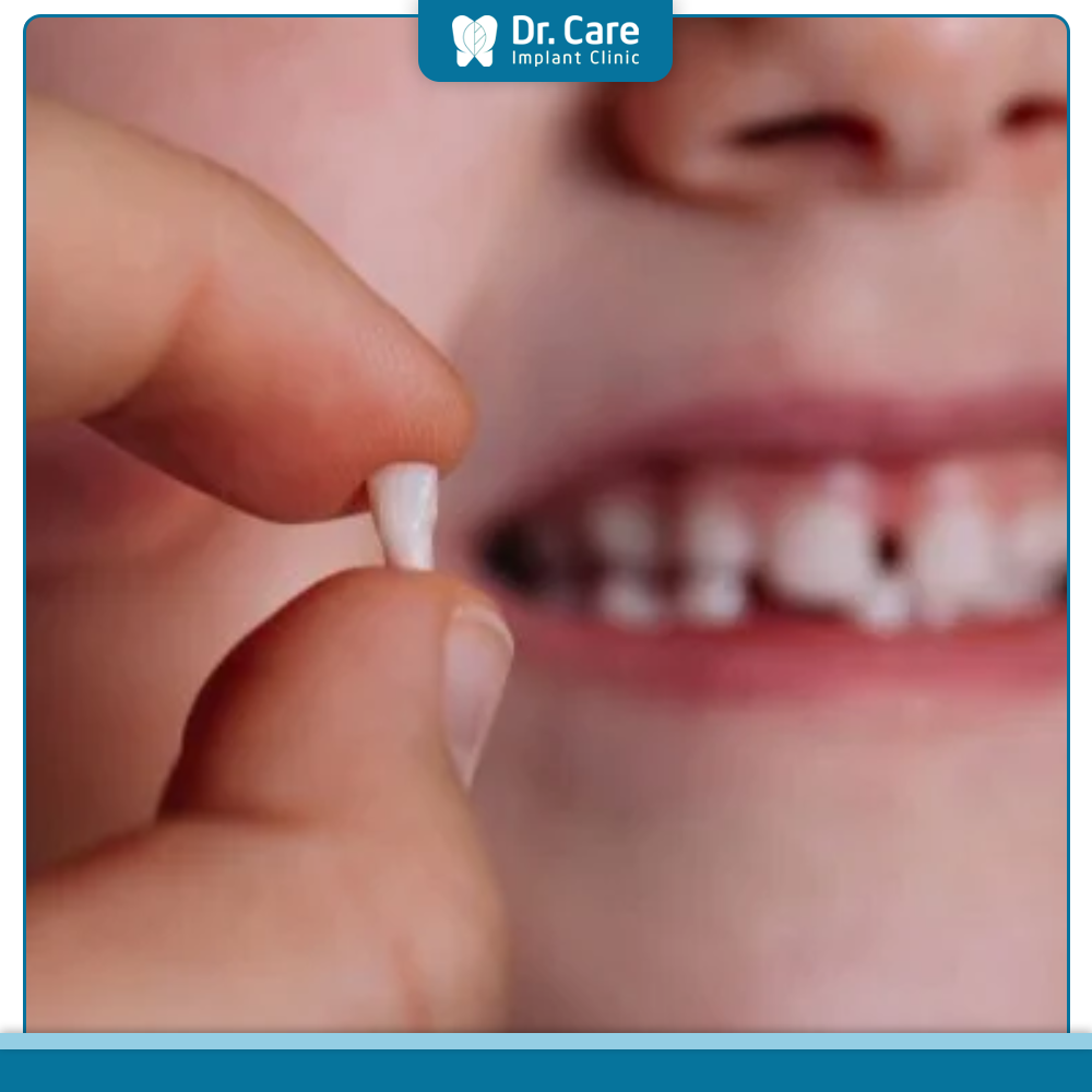 Nguyên nhân gây ra tình trạng răng đối đỉnh là gì?