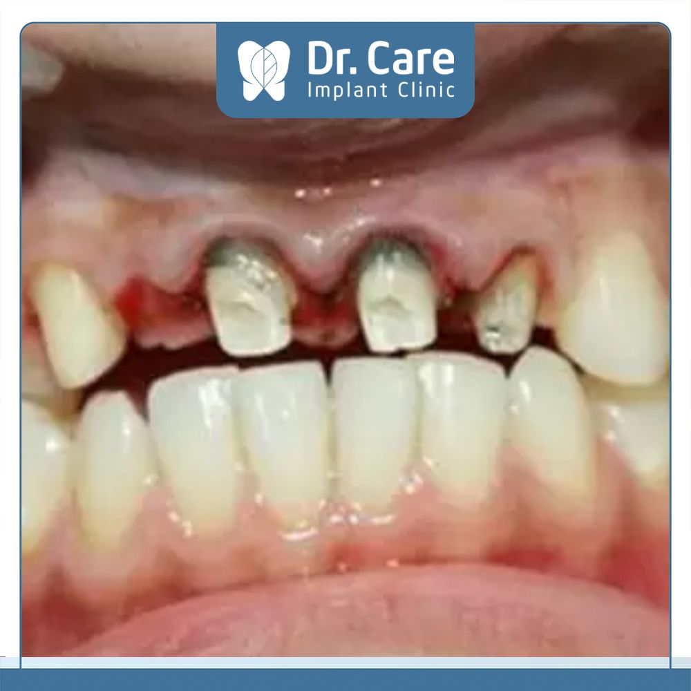 Biến chứng sau khi bọc răng sứ hỏng khiến hoại tử, viêm xương hàm dẫn đến mất răng