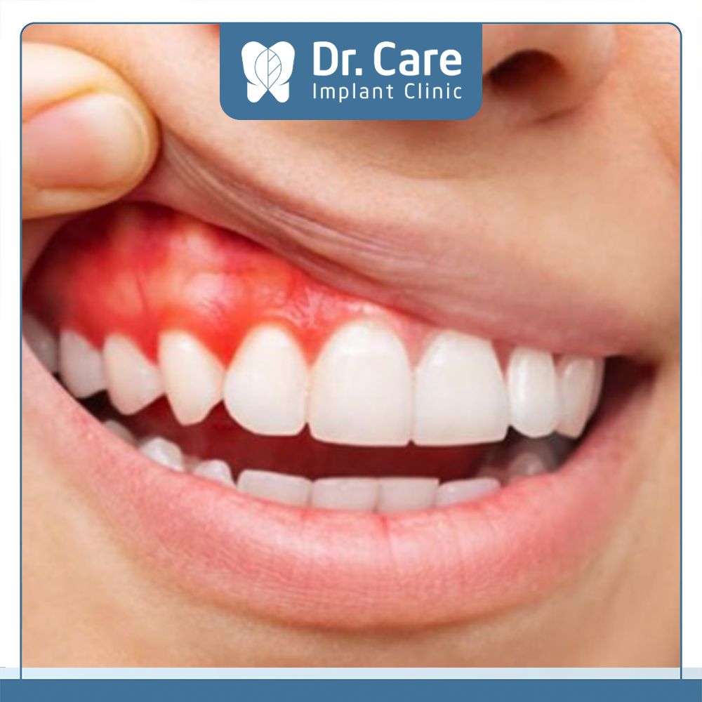 Tăng nguy cơ mắc bệnh lý răng miệng, viêm nướu, hôi miệng khi răng bọc sứ bị hỏng 
