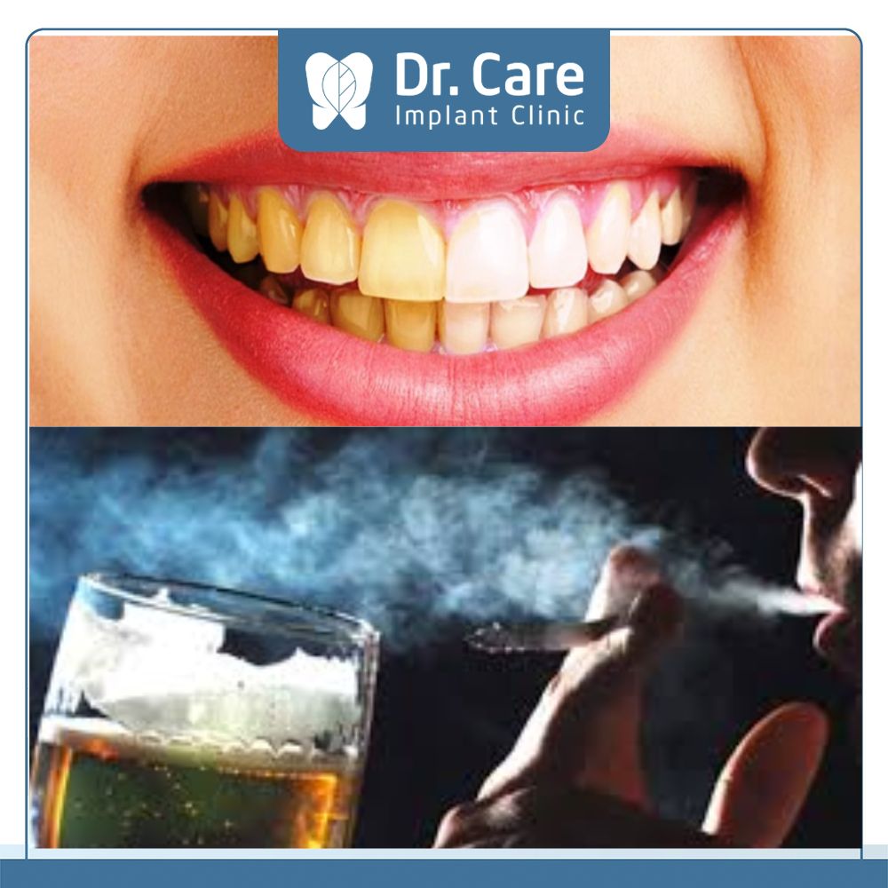 Thuốc lá, rượu bia là yếu tố hàng đầu gây ảnh hưởng tiêu cực đến kết quả của ca điều trị, gây hỏng răng sứ
