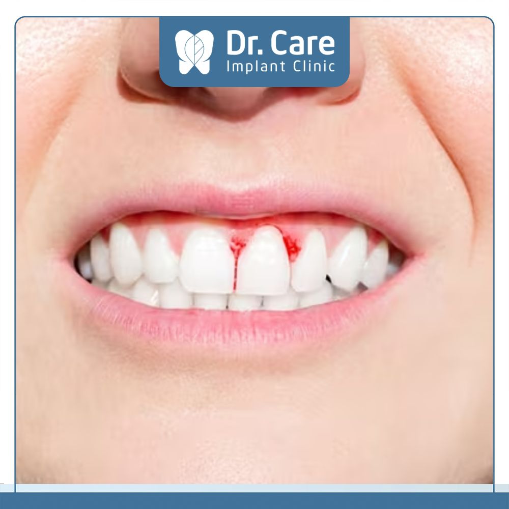 Bọc răng sứ xuất hiện tình trạng chảy máu chân răng thì đó cũng là một trong những dấu hiệu nhận biết ca điều trị sai cách, bị hỏng