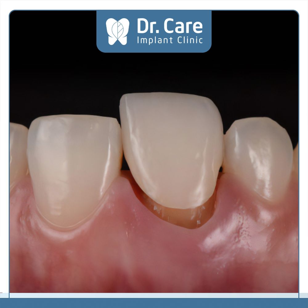 Răng sứ bị lung lay, lỏng lẻo là dấu hiệu cho thấy răng đã bị hỏng sau khoảng thời gian sử dụng