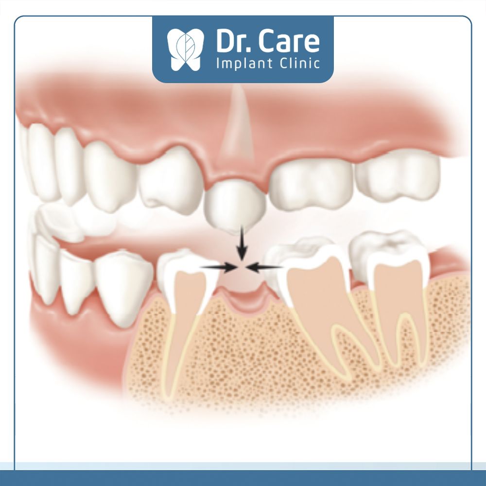 Bọc răng sứ chỉ phục hình phần thân răng, không thể tái tạo chân răng mới nên sẽ xuất hiện tình trạng tiêu xương hàm