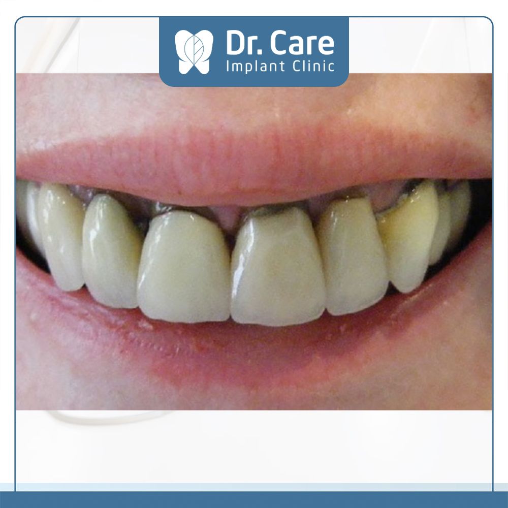 Khi bọc răng sứ hỏng sẽ làm đen viền nướu răng, nhiễm trùng chân răng, thậm chí ảnh hưởng đến tủy răng
