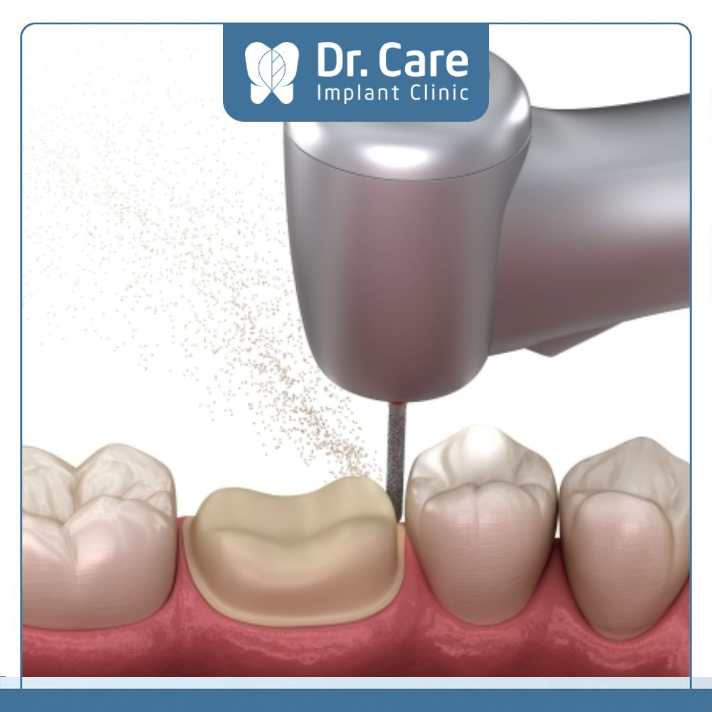 Mài răng bọc sứ mà vượt quá tỷ lệ cần thiết sẽ khiến cấu trúc răng trở nên yếu và nhạy cảm hơn, làm ca bọc răng sứ bị hỏng