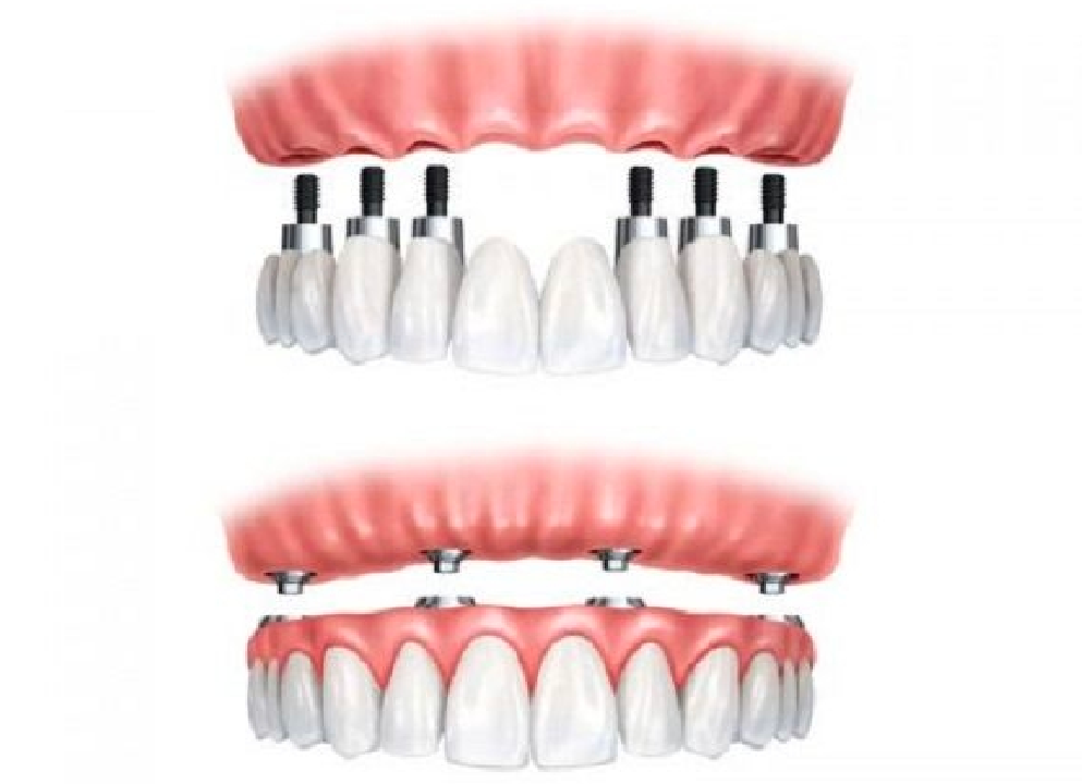 Trồng răng implant và phục hình tức thì